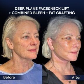 Before and after facelift, neck lift, blepharoplasty, fat grafting at Dr. Safa Manav Clinic result