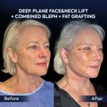 Before and after facelift, neck lift, blepharoplasty, fat grafting at Dr. Safa Manav Clinic result