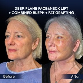 Before and after facelift, neck lift, blepharoplasty, fat grafting at Dr. Safa Manav Clinic result