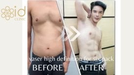 Vorher-nachher Vaser-Liposuktion für Sixpack bei ID Clinic Bangkok, sichtbares Ergebnis