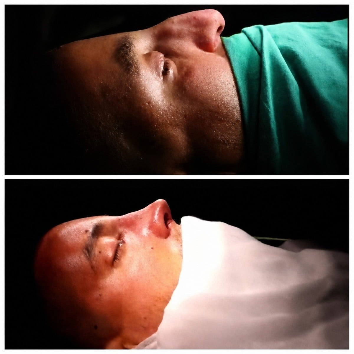 نتائج قبل وبعد تجميل طرف الأنف في مستشفى هيسار إنتركونتيننتال، إعادة تشكيل الأنف