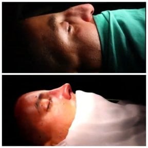 Résultats avant et après rhinoplastie de la pointe au Hisar Hospital Intercontinental