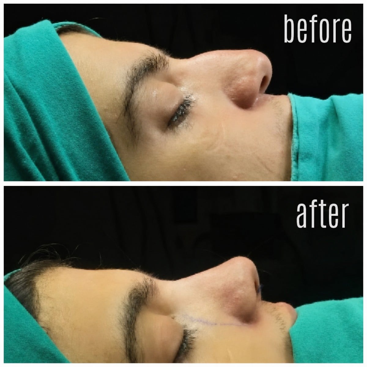 نتائج تجميل طرف الأنف قبل وبعد في مستشفى هيسار إنتركونتيننتال، شكل أنف محسّن