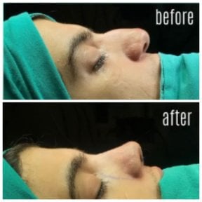 Résultats avant/après rhinoplastie de la pointe au Hisar Hospital Intercontinental