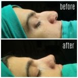 Résultats avant/après rhinoplastie de la pointe au Hisar Hospital Intercontinental