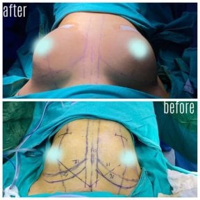 Результати до і після реконструкції грудей у Hisar Hospital Intercontinental