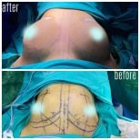 Результати до і після реконструкції грудей у Hisar Hospital Intercontinental