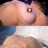 Результати до та після реконструкції грудей у Hisar Hospital Intercontinental