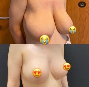 Результати до та після реконструкції грудей у Hisar Hospital Intercontinental