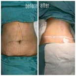 Efekty liposukcji brzucha przed i po w Hisar Hospital Intercontinental, modelowanie sylwetki