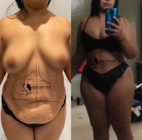 Before and after liposuction 3 body areas at Hisar Hospital Intercontinental, body contour result