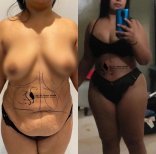 Before and after liposuction 3 body areas at Hisar Hospital Intercontinental, body contour result