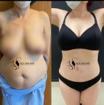 Before and after liposuction 3 body areas at Hisar Hospital Intercontinental, visible contour result