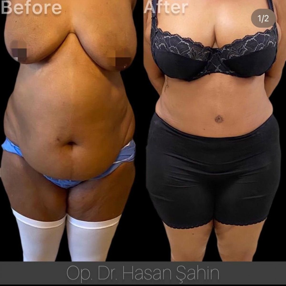 Resultado de liposucción en 3 zonas antes y después en Hisar Hospital Intercontinental