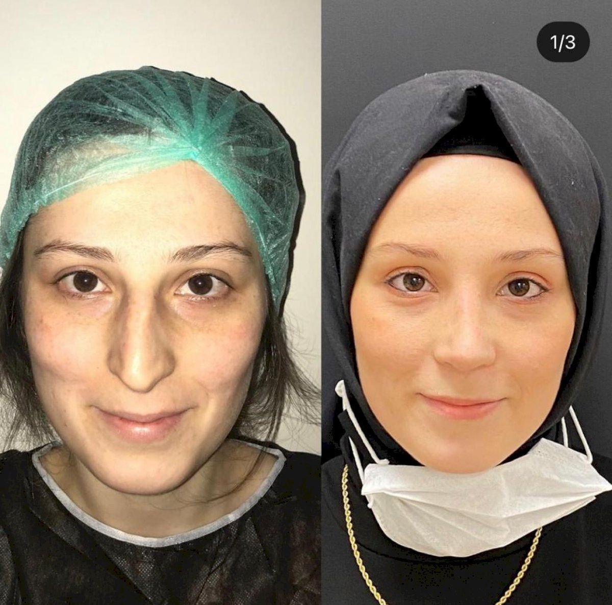نتائج قبل وبعد تجميل طرف الأنف في مستشفى هيسار إنتركونتيننتال، شكل أنف محسّن