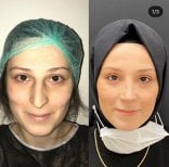Résultats avant et après rhinoplastie de la pointe au Hisar Hospital Intercontinental