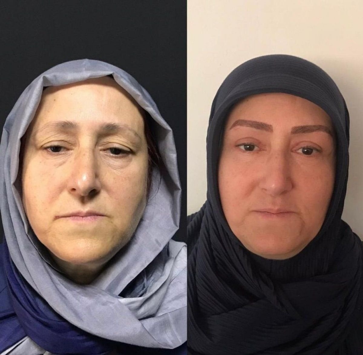 نتائج رفع الحاجب قبل وبعد في مستشفى هيسار، منطقة عين أكثر شباباً