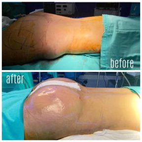 Before and after buttock lift results at Hisar Hospital Intercontinental, enhanced contour