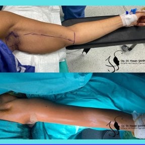 Resultados antes y después de lifting de brazos en Hisar Hospital Intercontinental, braquioplastia