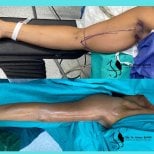 Resultados antes y después de lifting de brazos (braquioplastia) en Hisar Hospital Intercontinental