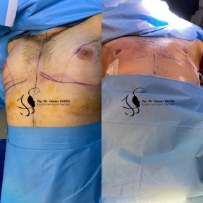 Before and after gynecomastia surgery results at Hisar Hospital Intercontinental, chest contour