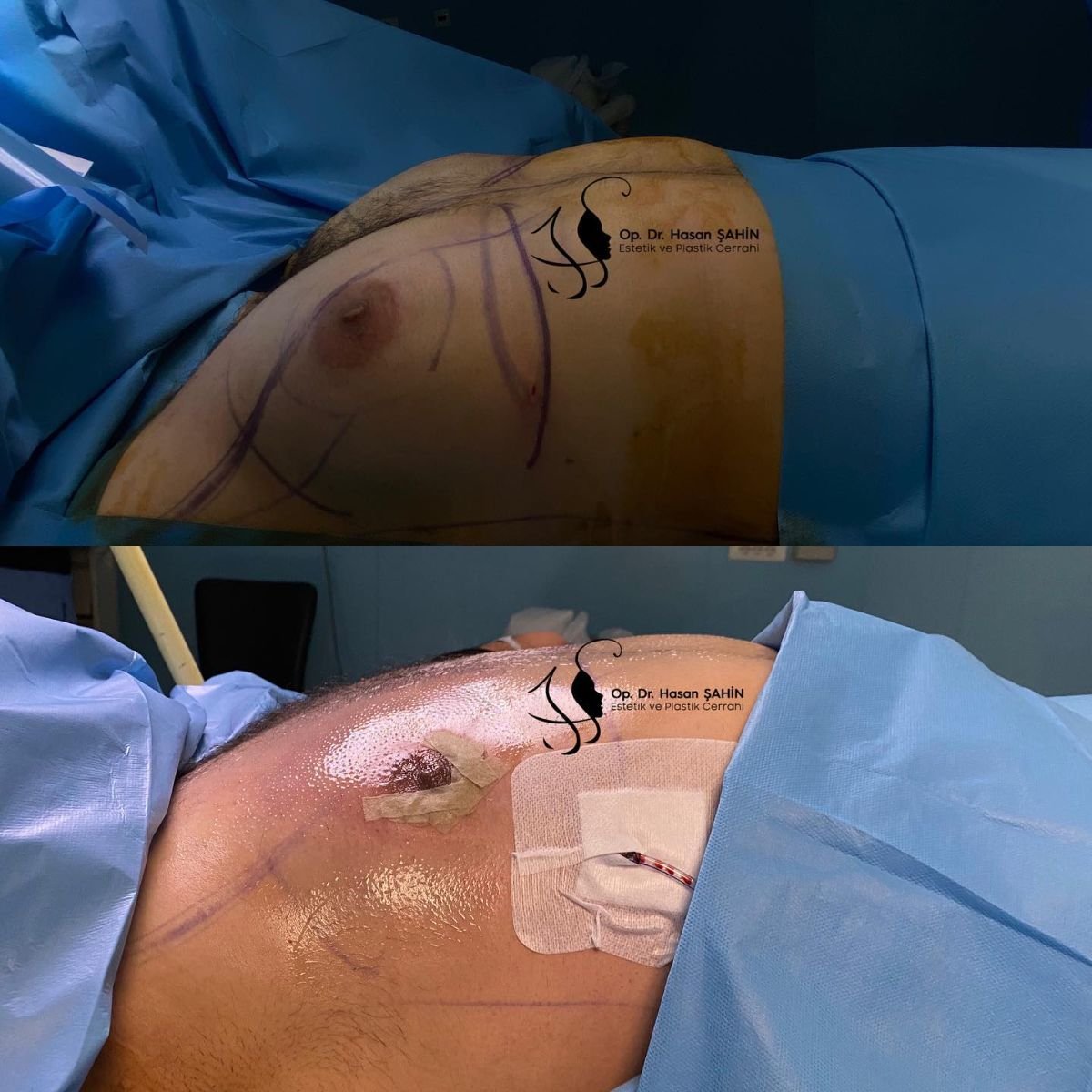 Resultados antes y después de ginecomastia en Hisar Hospital Intercontinental, contorno de pecho