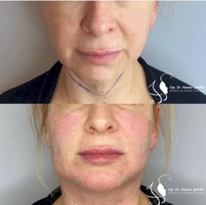 Efekty mini liftingu twarzy przed i po w Hisar Hospital Intercontinental, widoczne uniesienie