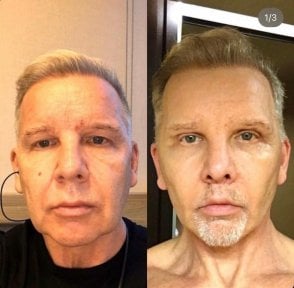 Efekty mini liftingu twarzy przed i po w Hisar Hospital Intercontinental, odmłodzenie