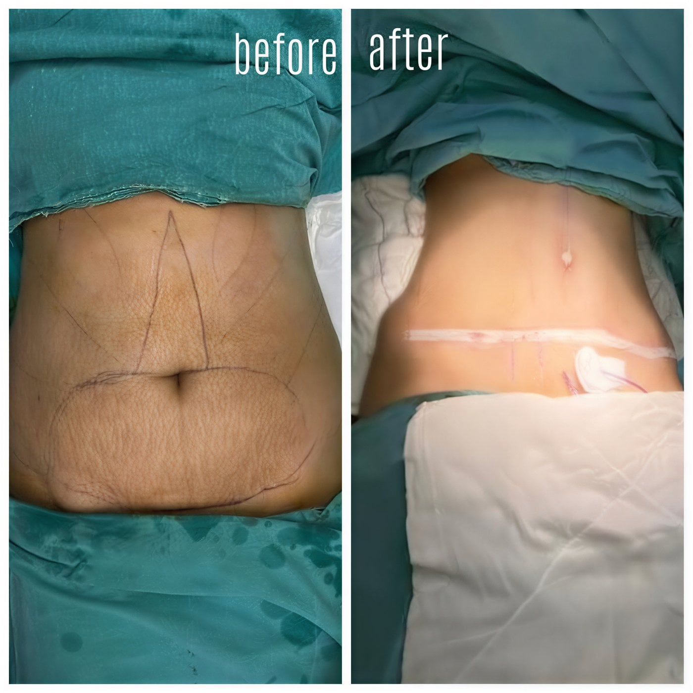 Resultados de abdominoplastia y liposucción antes y después en Hisar Hospital Intercontinental