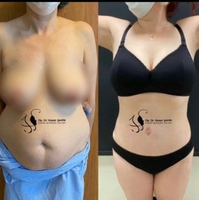 Resultados antes y después de abdominoplastia y liposucción en Hisar Hospital Intercontinental