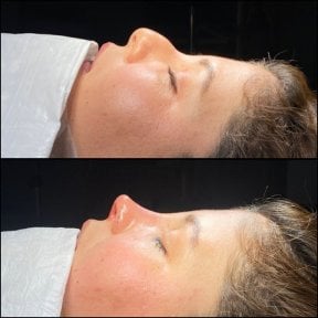 Результати до та після септопластики в Hisar Hospital Intercontinental, покращено профіль носа