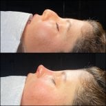 Результати до та після септопластики в Hisar Hospital Intercontinental, покращено профіль носа