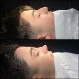 Результаты до и после септопластики в Hisar Hospital Intercontinental при искривлении перегородки