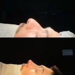 Результати до і після септопластики в Hisar Hospital Intercontinental, покращений профіль носа