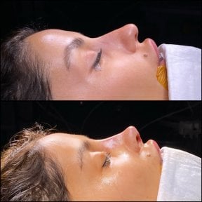 Результати до і після септопластики в Hisar Hospital Intercontinental при викривленій перегородці