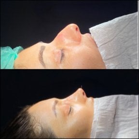 Результати септопластики до і після в Hisar Hospital Intercontinental, покращений профіль носа