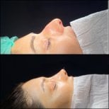 Результати септопластики до і після в Hisar Hospital Intercontinental, покращений профіль носа