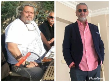 نتيجة قبل وبعد تكميم المعدة دا فينشي في مستشفى هيسار إنتركونتيننتال