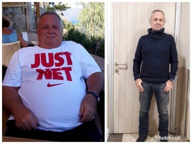 Результати до і після рукавної гастректомії Da Vinci у Hisar Hospital Intercontinental