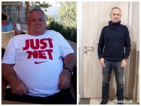 Результати до і після рукавної гастректомії Da Vinci у Hisar Hospital Intercontinental