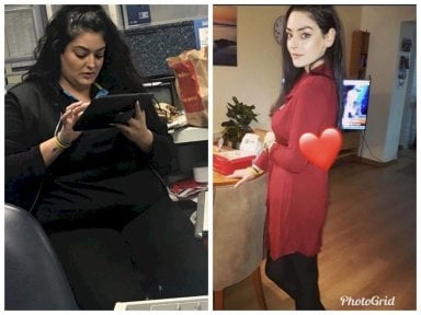 Результати до і після рукавної гастректомії Da Vinci у Hisar Hospital Intercontinental