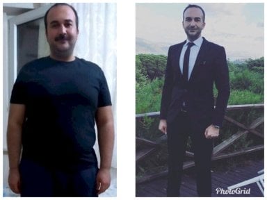 Результат до та після рукавної гастректомії Da Vinci у Hisar Hospital Intercontinental