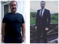 Результат до та після рукавної гастректомії Da Vinci у Hisar Hospital Intercontinental