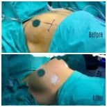 Resultados de lifting de senos antes y después en Hisar Hospital Intercontinental, mejor contorno