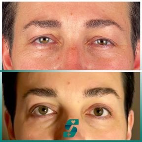 Vorher-nachher-Ergebnis Blepharoplastik bei Soraca Med Istanbul, Lidkorrektur