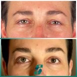 Vorher-nachher-Ergebnis Blepharoplastik bei Soraca Med Istanbul, Lidkorrektur