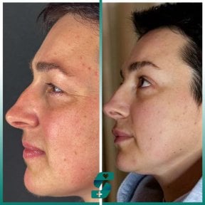 Vorher-nachher-Ergebnis der Blepharoplastik bei Soraca Med Istanbul, Lidkorrektur