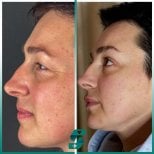 Vorher-nachher-Ergebnis der Blepharoplastik bei Soraca Med Istanbul, Lidkorrektur