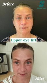 Vorher-nachher-Ergebnis obere Blepharoplastik bei Soraca Med Istanbul, Lidstraffung