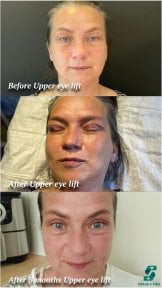 Oberlidstraffung Vorher-Nachher-Ergebnis bei Soraca Med Istanbul, nach 3 Monaten